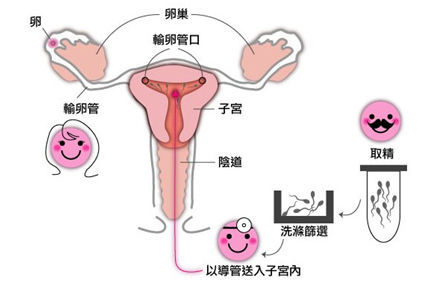 人工授精的见效率是多少